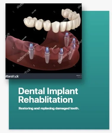 Dental Implant Rehabilitation