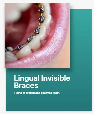 Lingual Invisible Braces