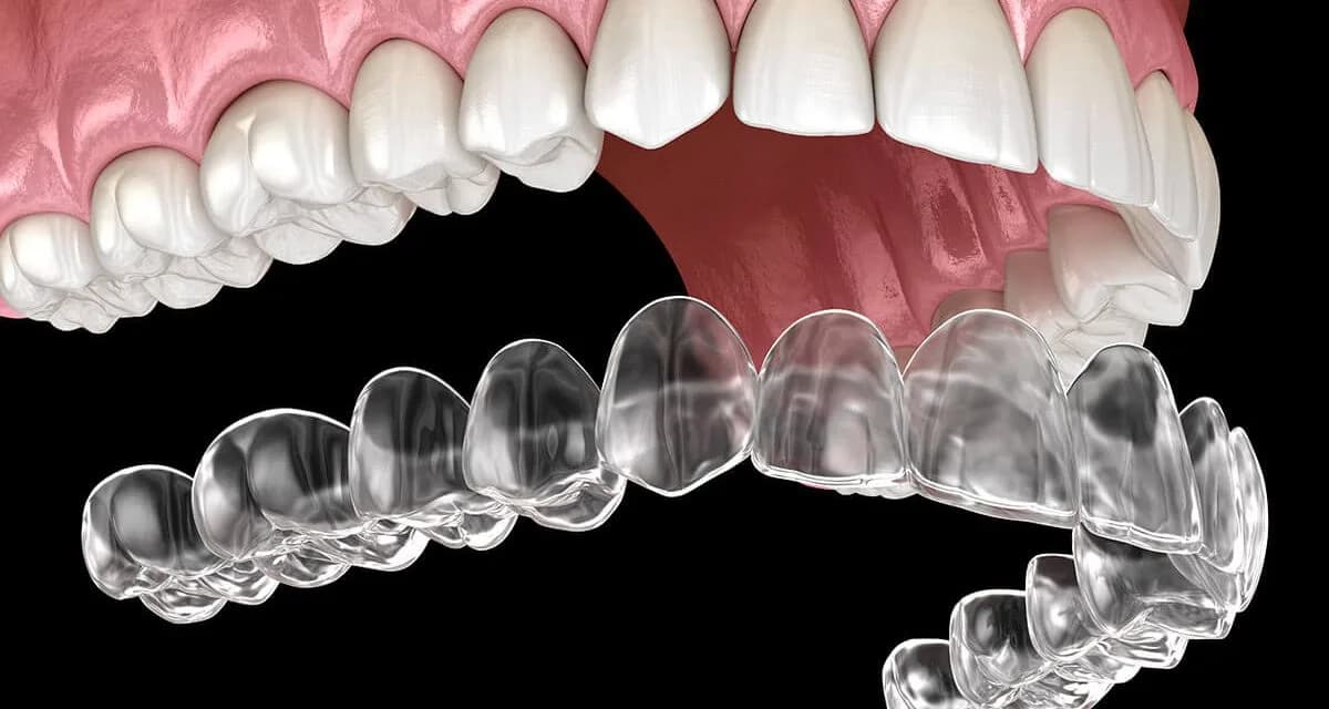 Clear Aligners at Shwetha Dentistry, Kalaburagi