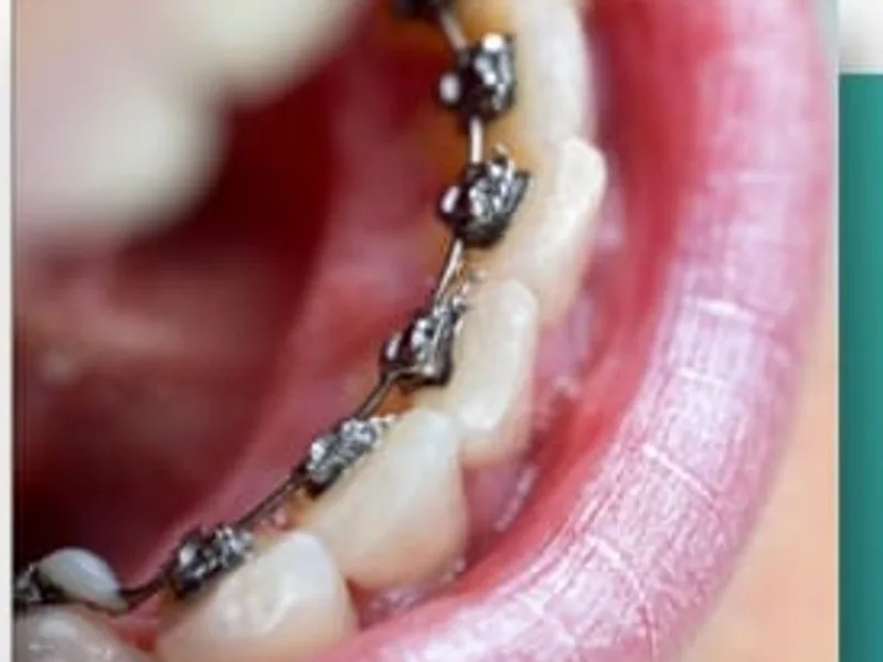 Lingual Braces at Shwetha Dentistry, Kalaburagi
