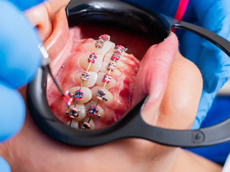 Metal Braces at Shwetha Dentistry, Kalaburagi