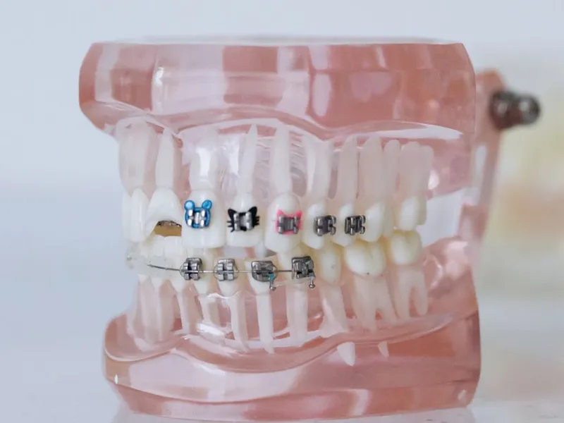 Self-Ligating Braces at Shwetha Dentistry, Kalaburagi